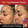 Skin tag removal cream