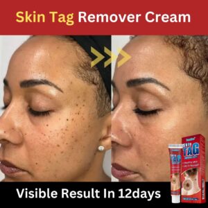 Skin tag removal cream